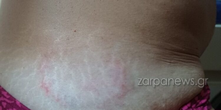 Χανιά: Θαλάσσια χελώνα δάγκωσε γυναίκα στα ρηχά – Δείτε φωτογραφίες