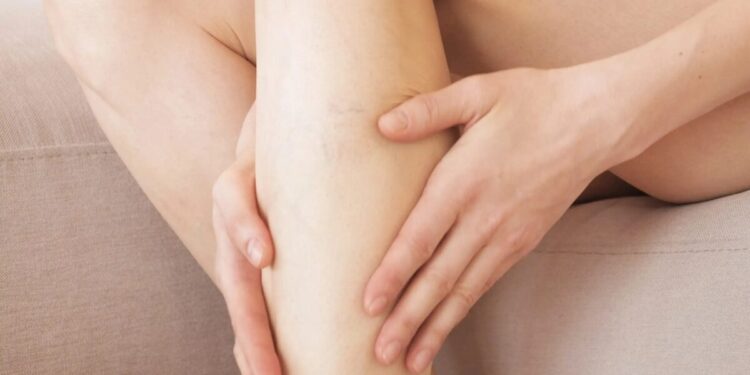 Χρόνια φλεβική νόσος: Η σιωπηλή νόσος που εμφανίζεται «αθόρυβα» – Διαγνώστηκαν 7 στους 10 Έλληνες που εξετάστηκαν για πρώτη φορά