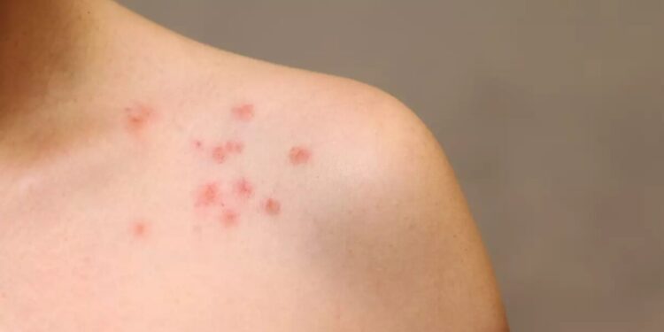 Αναφυλαξία και αλλεργικό σοκ: Τα συμπτώματα και η αντιμετώπιση