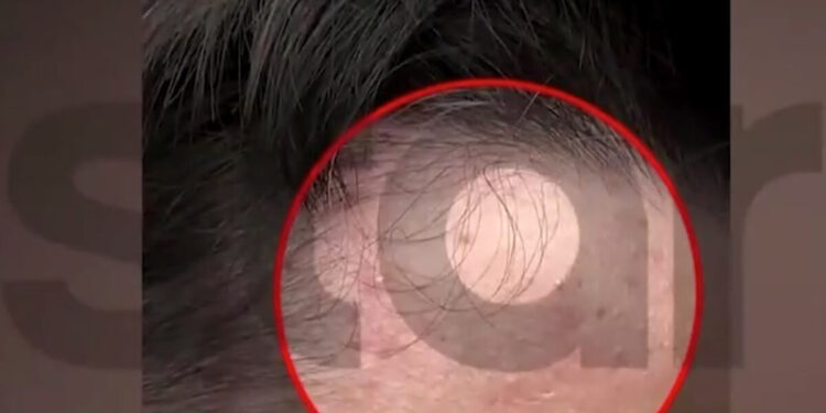 Άγριος ξυλοδαρμός 14χρονου από συμμαθητές του σε προαύλιο σχολείου: «Ήταν επτά και με χτύπησαν για λάθος πάσα στο μπάσκετ»