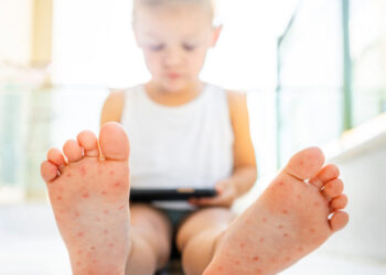 Σε έξαρση ο ιός Κοξάκι στα παιδιά: Οι 3 περιοχές με τα περισσότερα κρούσματα και το ανησυχητικό «κοκτέιλ» με τη γρίπη