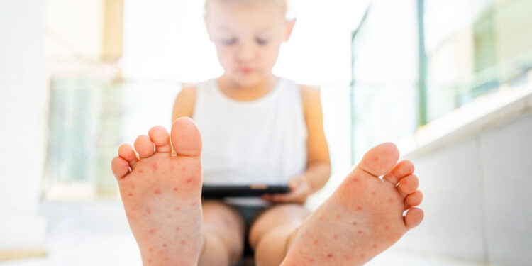 Σε έξαρση ο ιός Κοξάκι στα παιδιά: Οι 3 περιοχές με τα περισσότερα κρούσματα και το ανησυχητικό «κοκτέιλ» με τη γρίπη