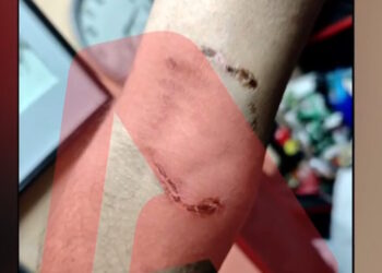 Ομόνοια: Νεαρός έβαλε το πίτμπουλ του να επιτεθεί σε 30χρονο για να τον ληστέψει – «Με έριξε κάτω και το σκυλί με δάγκωνε»