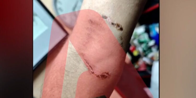 Ομόνοια: Νεαρός έβαλε το πίτμπουλ του να επιτεθεί σε 30χρονο για να τον ληστέψει – «Με έριξε κάτω και το σκυλί με δάγκωνε»